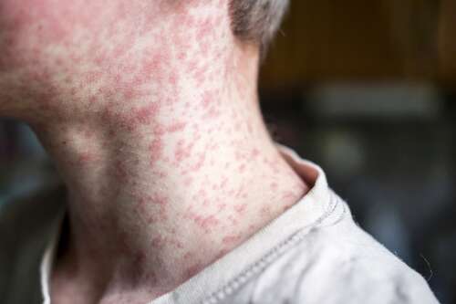 Measles case reported in DuPage