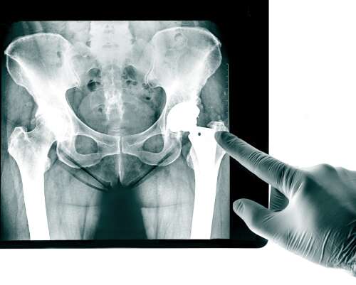 Patient advocate: Tips for hip, knee replacement surgery