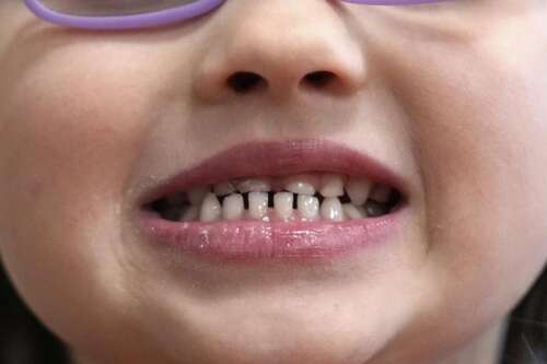 FDA and RFK Jr. Target Ingestible Fluoride Products for Children’s Dental Health
