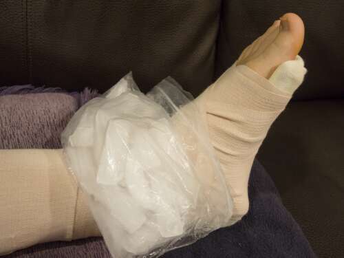 There’s a new way to treat sprains. Hint: Ice is out.