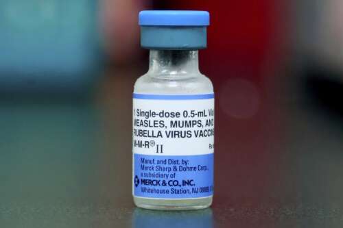 With 53 cases of measles recorded in the city and suburbs, when does it peak? - Vimarsana News