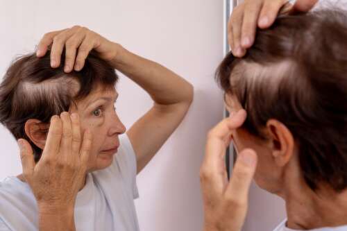3 types of hair loss and the treatments that help